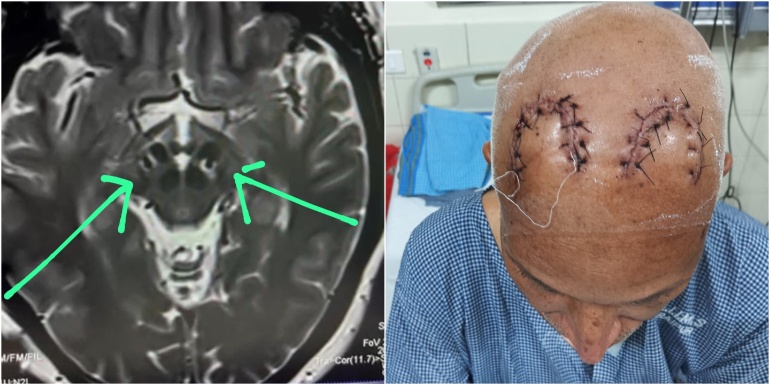 Deep Brain Stimulation Surgery